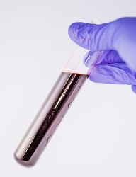 Scotland AR phlebotomist holding blood sample